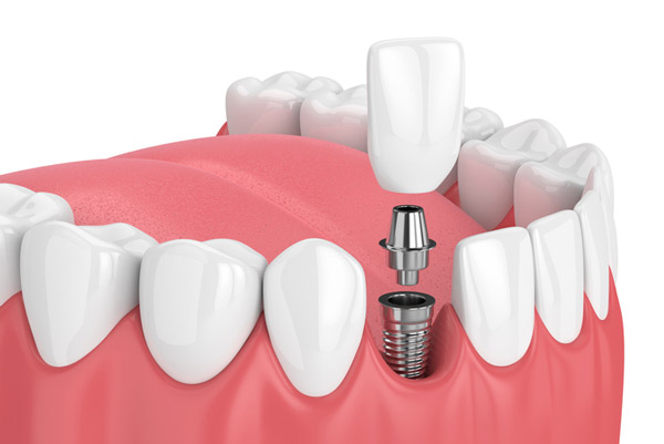 Why Choosing the Right Implant Dentist Can Transform Your Smile