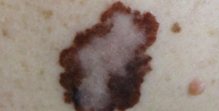 What Are the Best Acne and Rosacea Treatments in Huntington Beach CA? Friendly Tips to Clear Your Skin What Are the Best Acne and Rosacea Treatments in Huntington Beach CA? Friendly Tips to Clear Your Skin