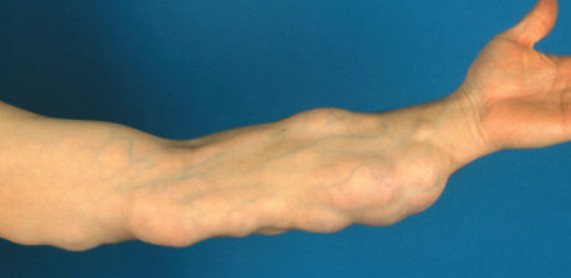 What’s the Best Way to Treat Basal Cell Carcinoma in Laguna Hills CA? What’s the Best Way to Treat Basal Cell Carcinoma in Laguna Hills CA?