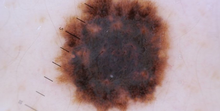 How to Find the Right Melanoma Treatment in Irvine, CA: A Friendly Guide for Healthier Skin