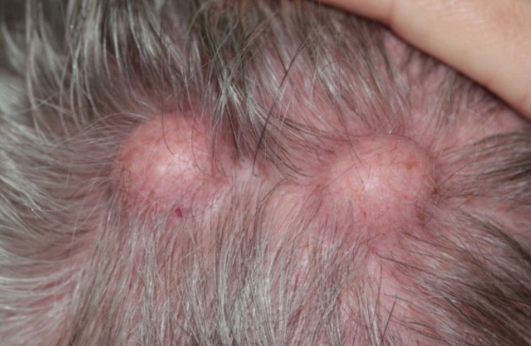 Is Your Sun Spot Actually Pre-Cancer? The Ultimate Guide to Treatment in Irvine